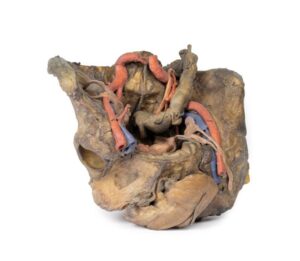 Modelo de Disección Profunda de Pelvis Femenina