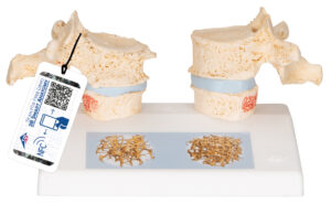 Modelo de Osteoporosis