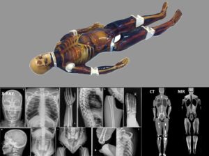 Simulador Adulto de Cuerpo Completo para Radiografía - Tomografía Computarizada - Resonancia Magnética